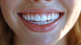 Каппы Invisalign